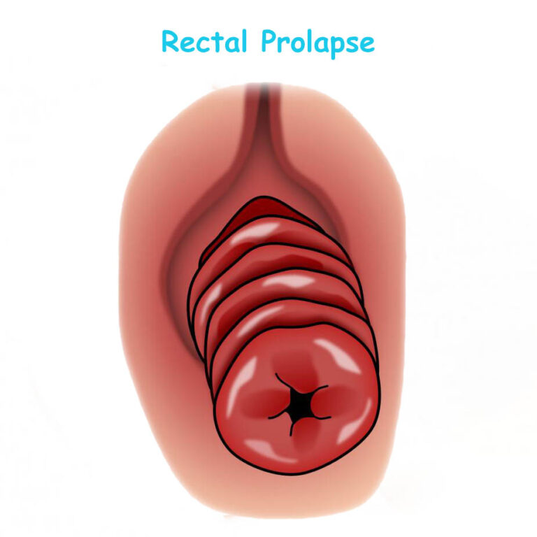 Painful Rectal Prolapse: Finding Comfort and Hope in Recovery